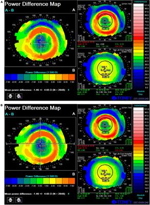 Effect of treatment zone decentration on axial length growth after orthokeratology